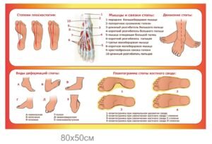 Стенд «Плоскостопість»
