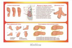 Стенд “Види деформації ступні”